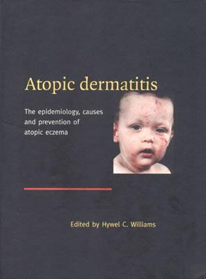 【预订】Atopic Dermatitis