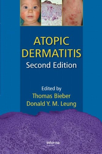 【预订】Atopic Dermatitis, Second Edition