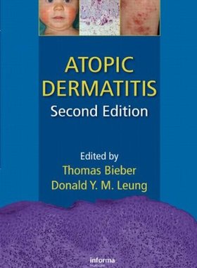 【预订】Atopic Dermatitis, Second Edition