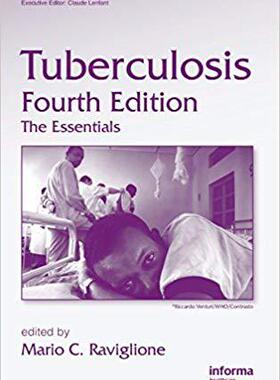 【预订】Tuberculosis