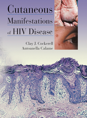 【预订】Cutaneous Manifestations of HIV Disease