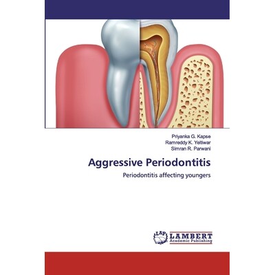 预订 Aggressive Periodontitis:Periodontitis affecting youngers: Periodontitis affecting youngers 侵袭性牙周炎:牙周炎影响