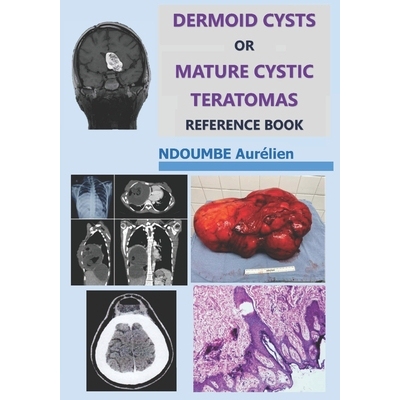 预订 Dermoid Cysts or Mature Cystic Teratomas: Reference Book: 9798274953122