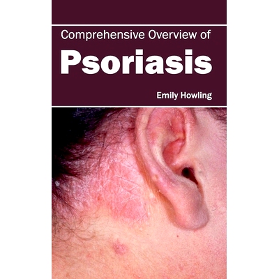预订 Comprehensive Overview of Psoriasis 银屑病综合概述: 9781632420893