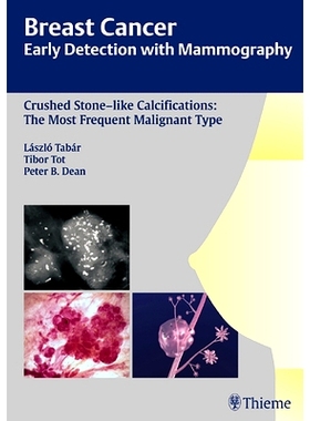 预订 Breast Cancer: Early Detection with Mammography: Crushed Stone-like Calcifications: The Most Frequent Malignant Typ
