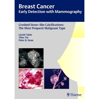 预订 Breast Cancer: Early Detection with Mammography: Crushed Stone-like Calcifications: The Most Frequent Malignant Typ