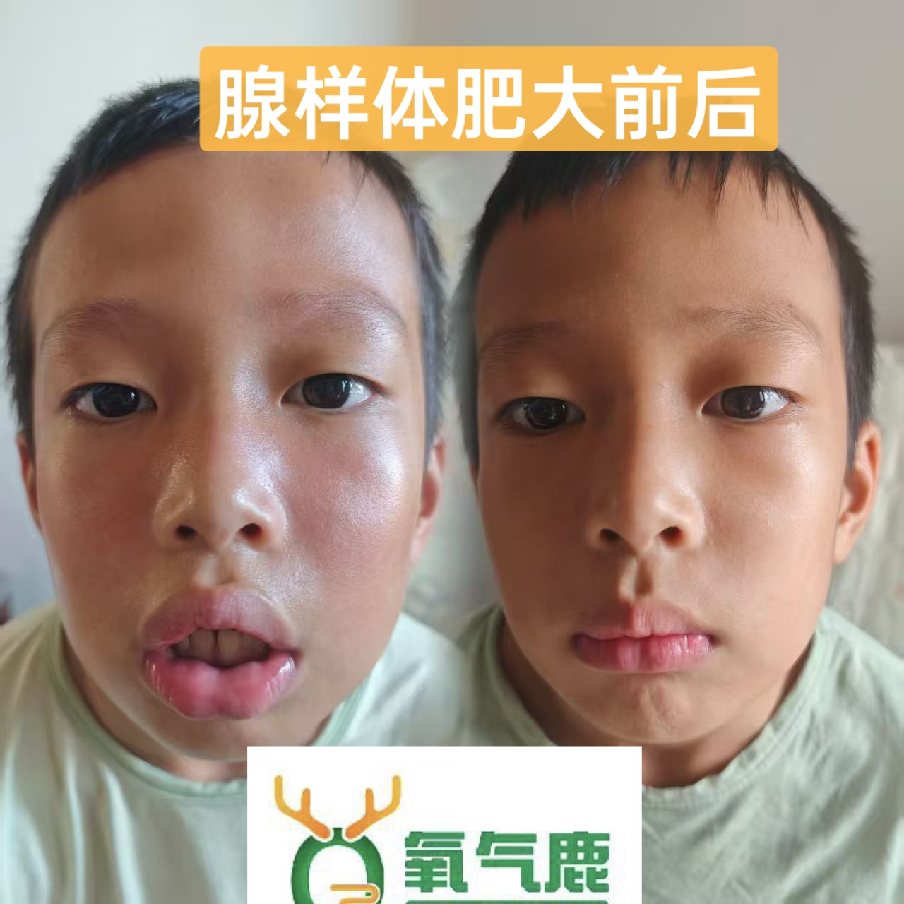 儿童腺样体肥大中药贴鼻塞张嘴呼吸打呼噜面容矫正疗程三个月