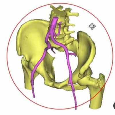 3matic mimics三维重构geomagic分析abaqus仿真hypermesh仿真