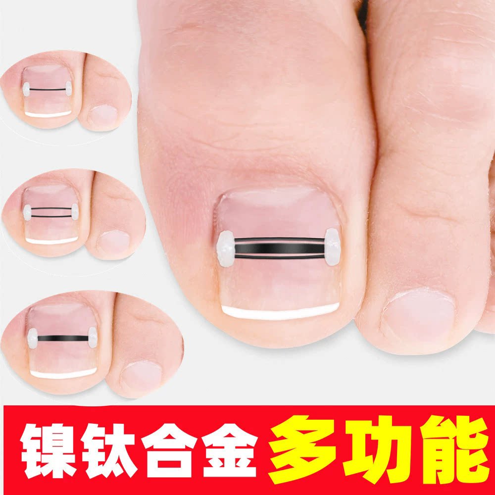 嵌甲指甲长肉里轻松矫正指甲