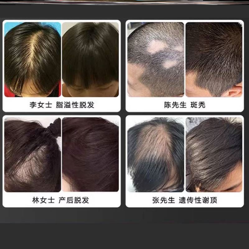 防脱育发精华排行榜第一名旗舰店发仁和匠心生发液德国生增发纤维