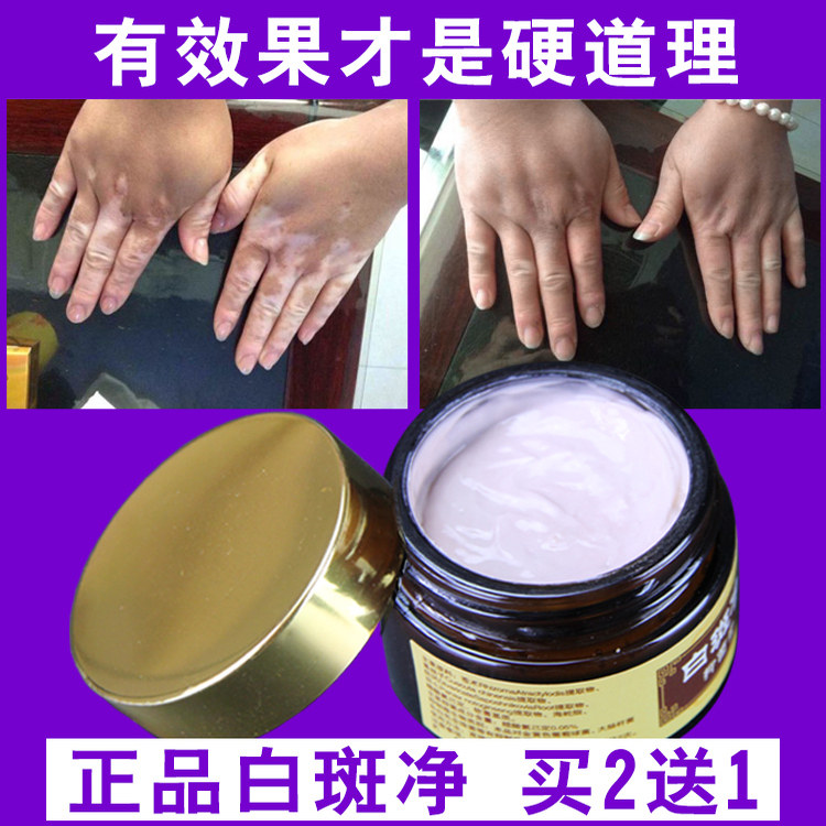 白癜外用黑色素生长白斑净补骨脂酊软膏消白1