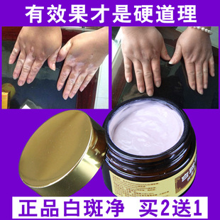 白癜外用黑色素生长白斑净补骨脂酊软膏消白1