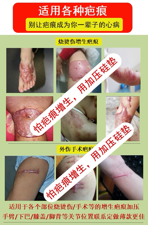 弹力套疤痕加压垫硅胶垫压力垫疤痕增生压力套烧烫伤术后疤痕贴