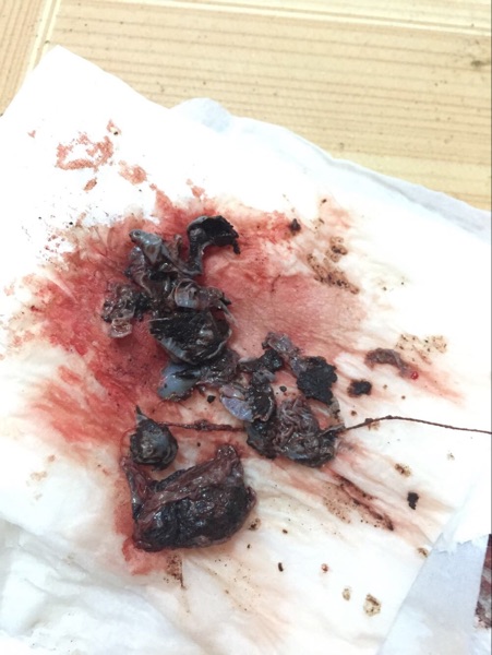 人乳头状病毒高危清宫丸熹清宫美颜丹月经量少色黑清子宫垃圾hpv