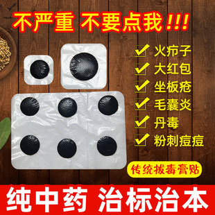 火疖子拔毒拔脓膏脓包硬块神器屁股坐板疮贴粉瘤去除囊肿痘痘特效