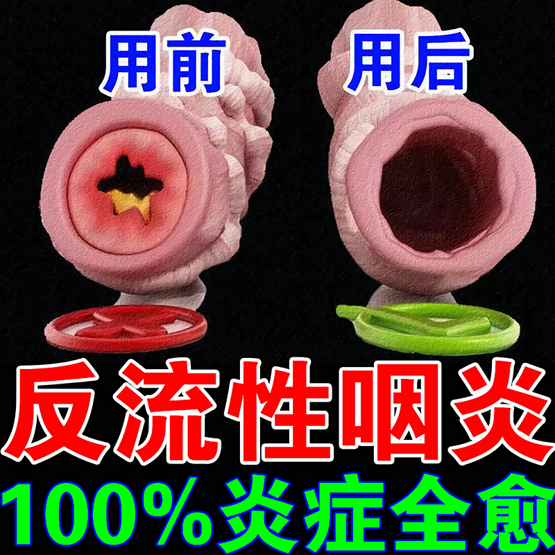 反流性咽炎慢性咽炎茶异物感喷雾根治滤泡增生除根贴治疗咽喉炎