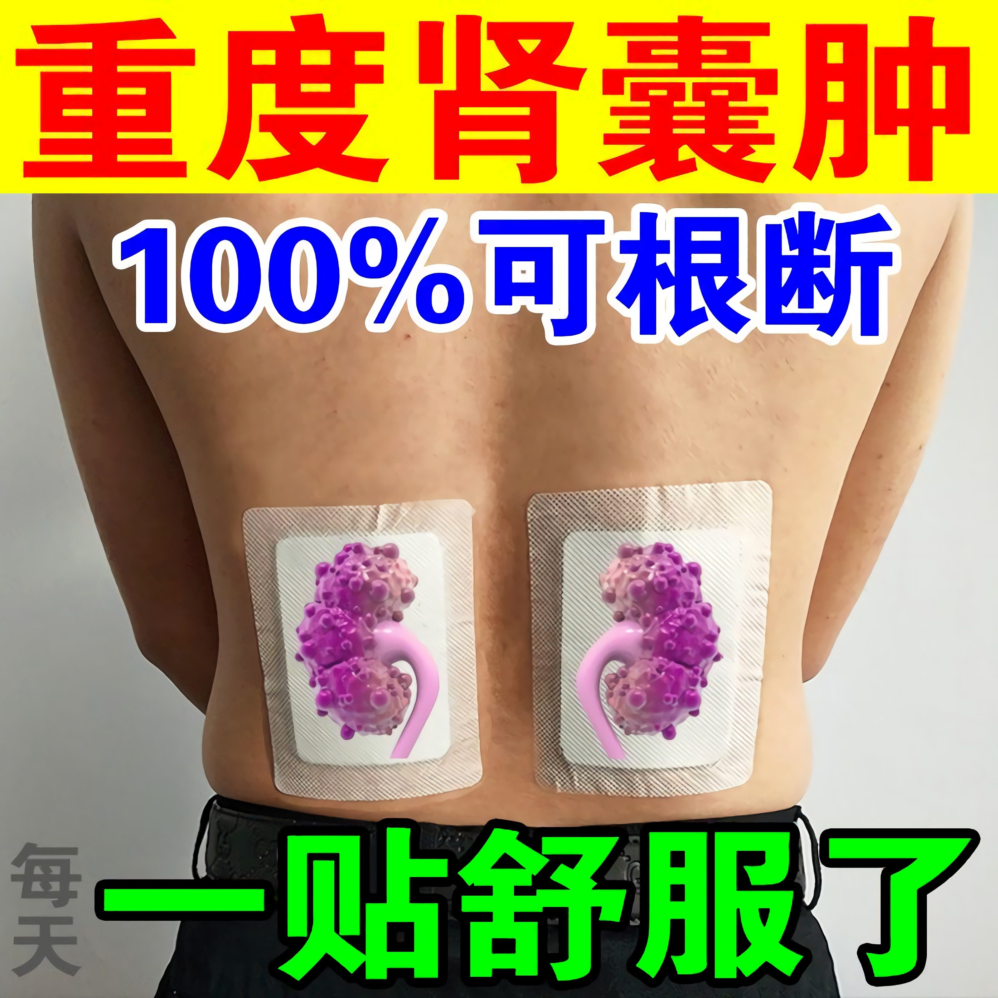 肾囊肿药特效治疗腰腹疼痛肿块尿血蛋白尿多囊肾的专用中药穴位贴