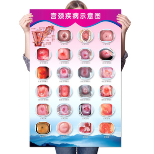 医院妇科健康知识宣传画宫颈疾病糜烂示意图女性生殖器解剖图挂图