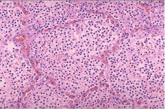 高教科研生物切片病理切片,大叶性肺炎