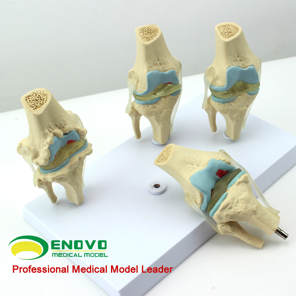 颐诺正品人体病理膝关节模型血友病退行性膝关节病发炎膝关节模型