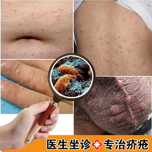 疥疮膏疥疮结节一扫光疥虫螨虫阴虱硫磺软膏皮肤瘙痒止痒特效药膏