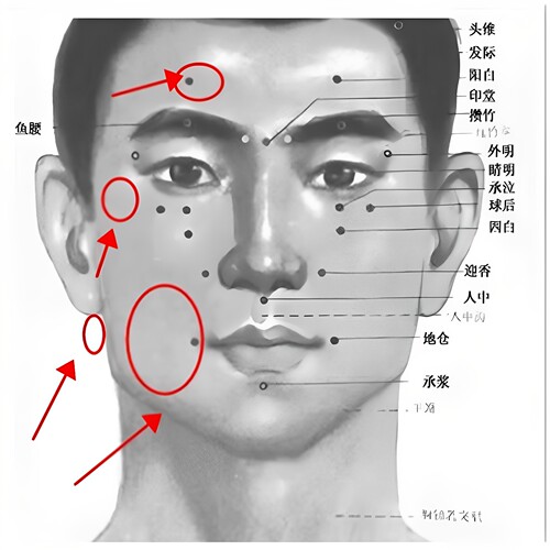 面   贴牵正膏大小眼口眼联动嘴歪 面肌痉挛后遗症