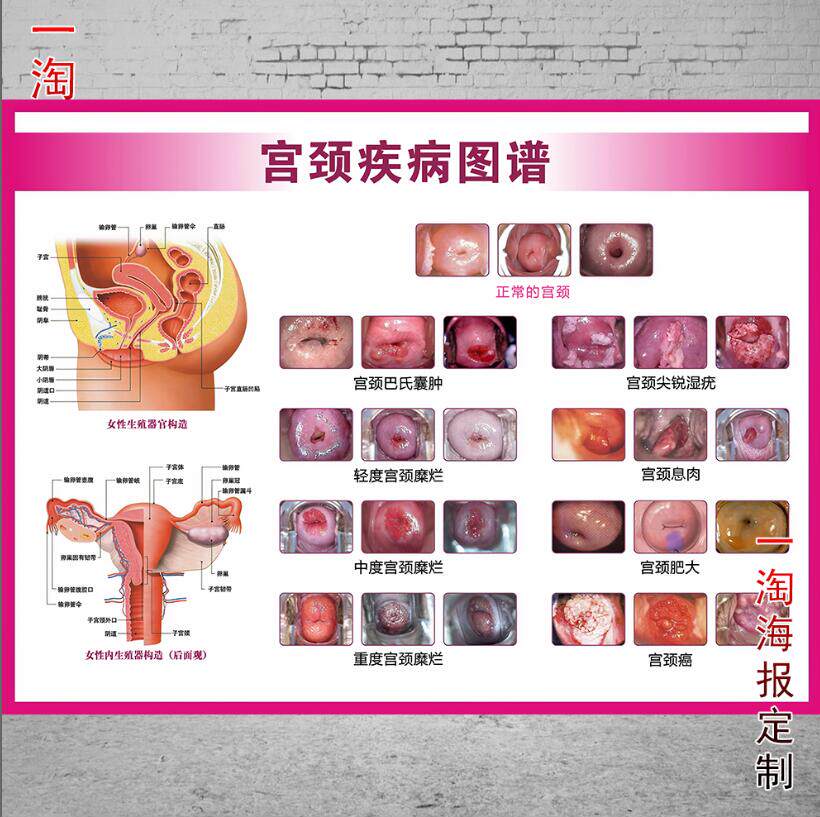 美容院宣传海报设计挂图定制做宫颈疾病图谱无框画广告装饰壁画图