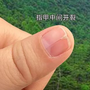 指甲盖中间竖纹裂开指甲有竖纹指甲表面凸起凹凸不平指甲防裂修复