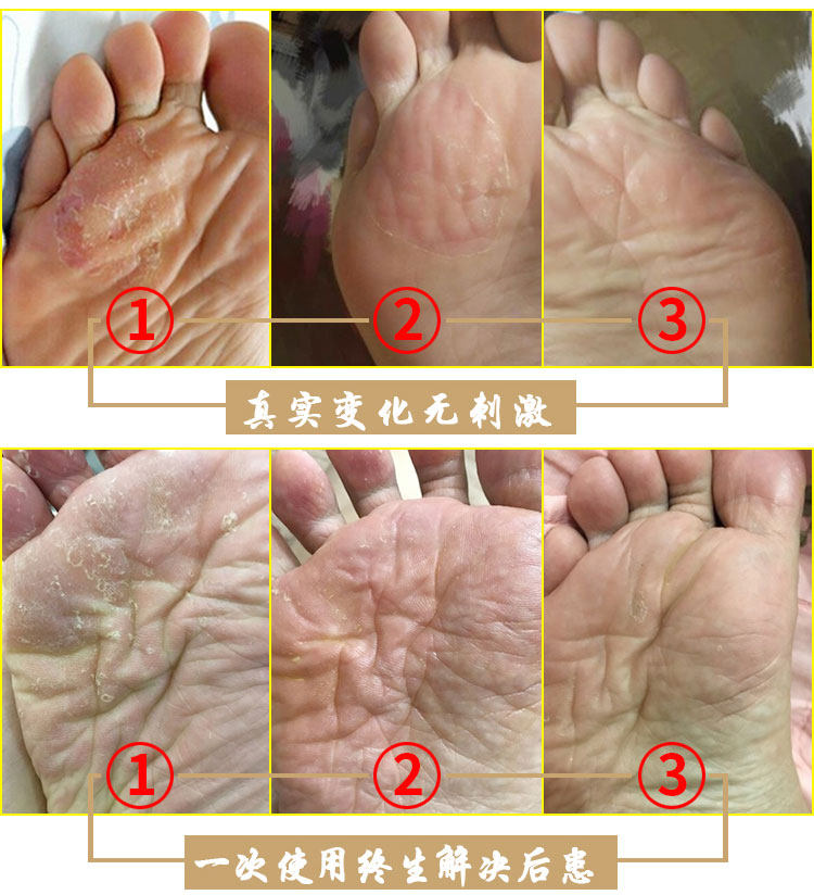 脚气中药泡脚水烂脚丫
