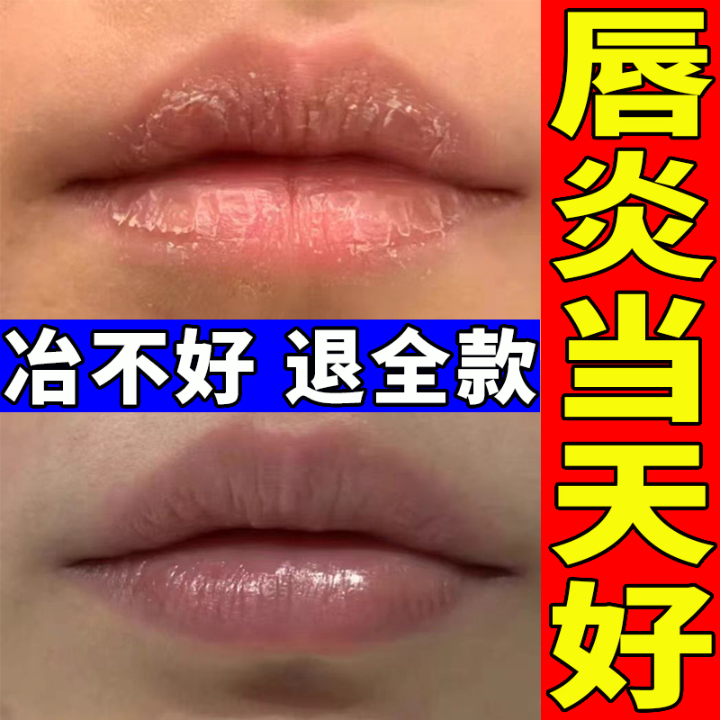 唇炎润唇膏嘴唇干裂脱皮专用保湿滋润去死皮口角炎疱疹医用修护膏