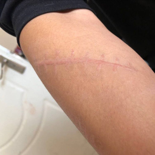 刀疤贴疤痕价格 刀疤贴疤痕图片 星期三