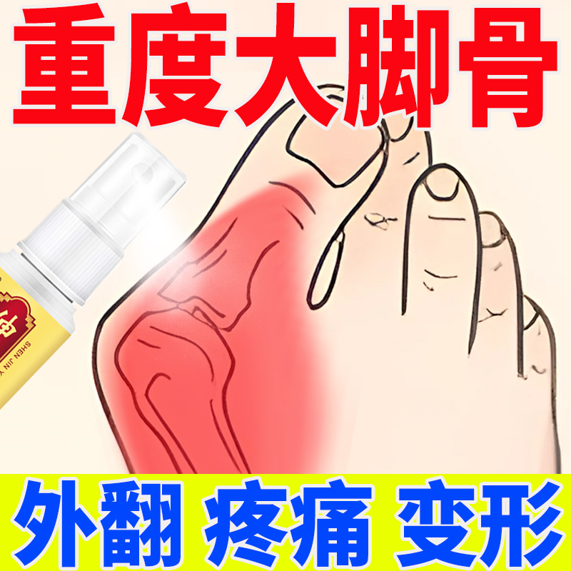 正品严重拇指外翻正品脚骨凸出脚趾重叠畸形肿胀疼