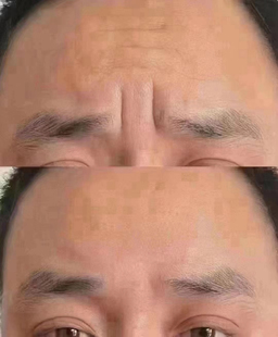 草本去眉间皱纹笑纹 除额头纹眼角纹嘴角纹手背纹精油