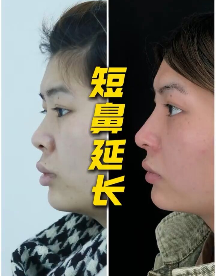 草本短鼻延长精华 改善鼻子过短增长立体精致鼻部加强版