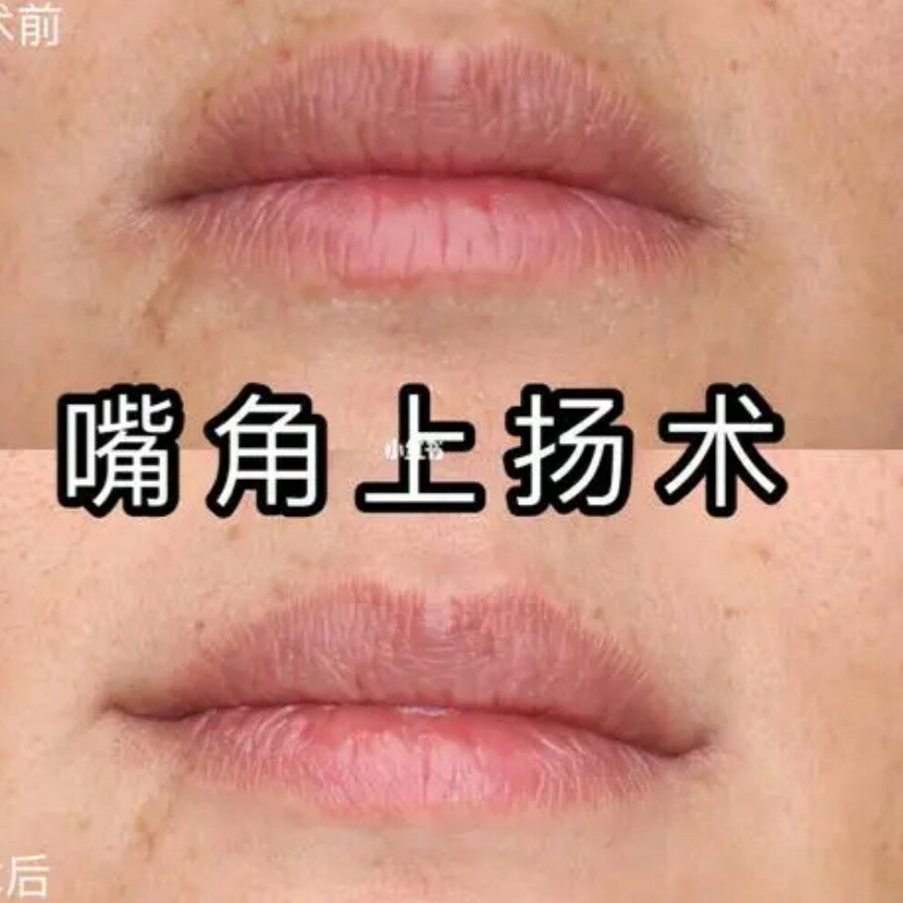 草本嘴角上扬精华 改善提升下垂精油