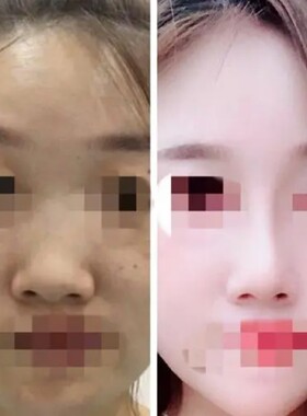 草本鼻尖成型精华改善提升挺翘美鼻塑形精油