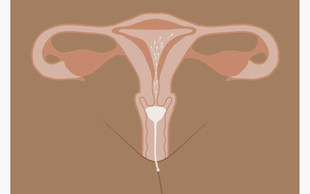 (赠品)家庭人工授精宫颈帽法备孕工具推注器输精受孕器注射采集