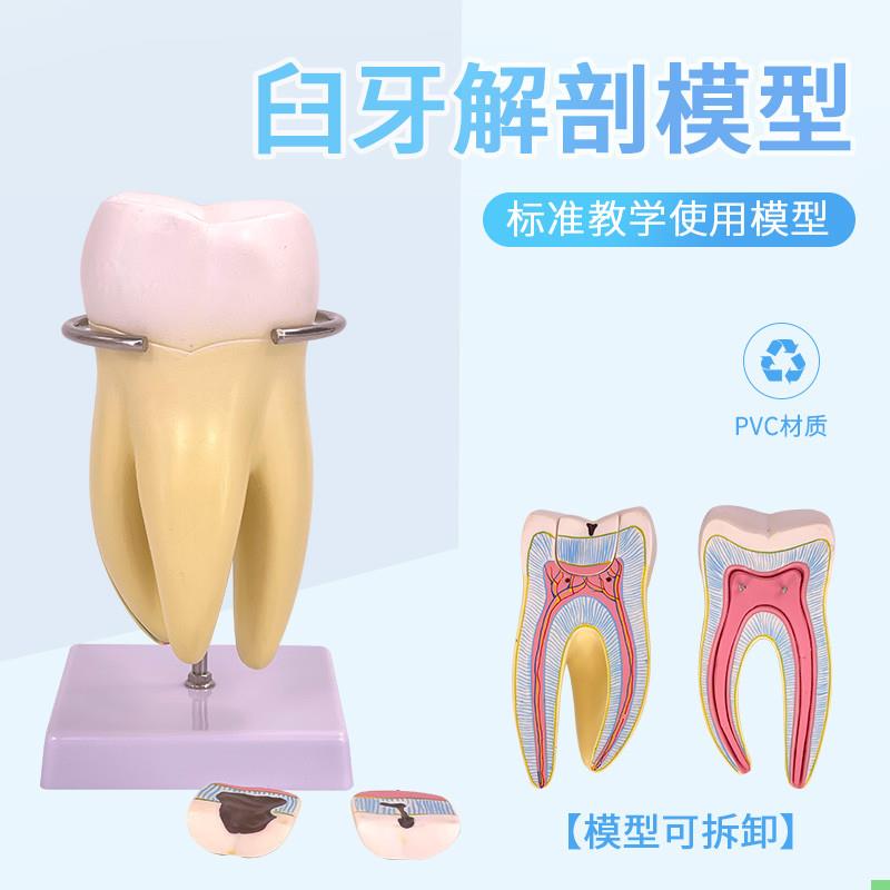 口腔蛀牙模型 磨牙解剖放大模型 人体病理3倍放大磨牙模型6件套