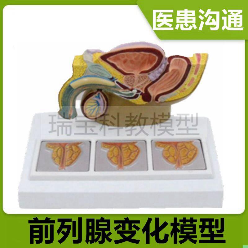 前列腺比较模型病理变化增大生肥尿道狭窄男科医患中老年人前列腺