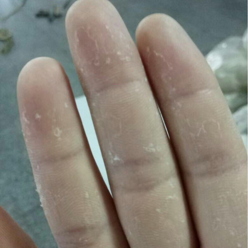 手脱皮护手霜严重脱皮专用手指头干裂手掉皮手掌爆皮退褪皮手起皮
