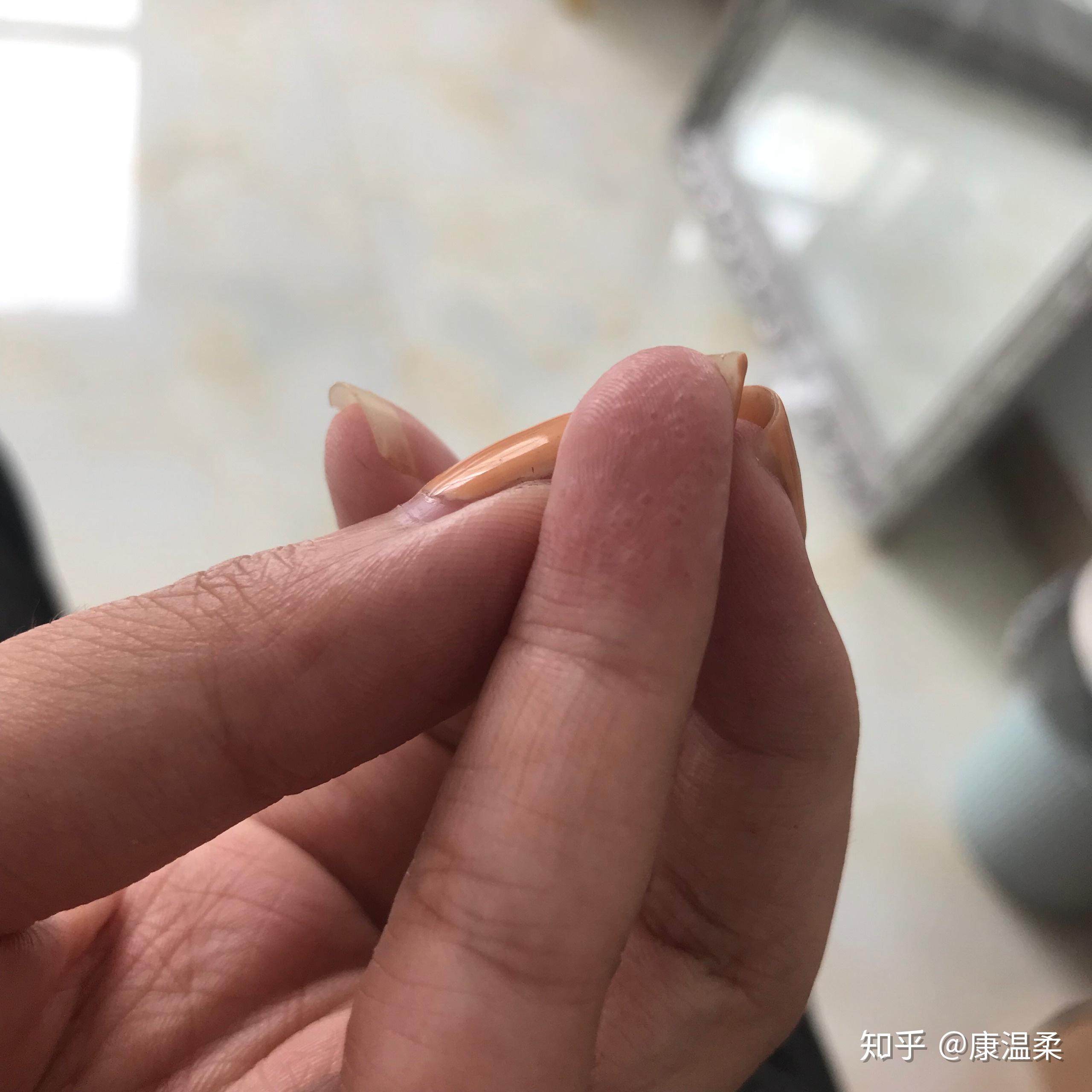 手脱皮水泥过敏建筑用手痒起泡泡皮肤手脱皮长藓的痒痒膏