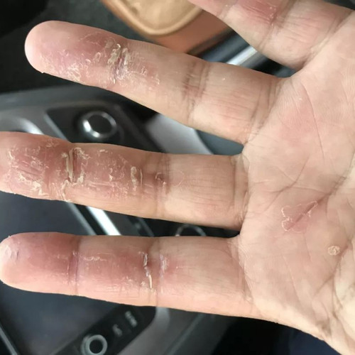 抖音手脱皮膏手上起皮干燥严重蜕皮专用儿童手指手掌脚心干裂掉皮