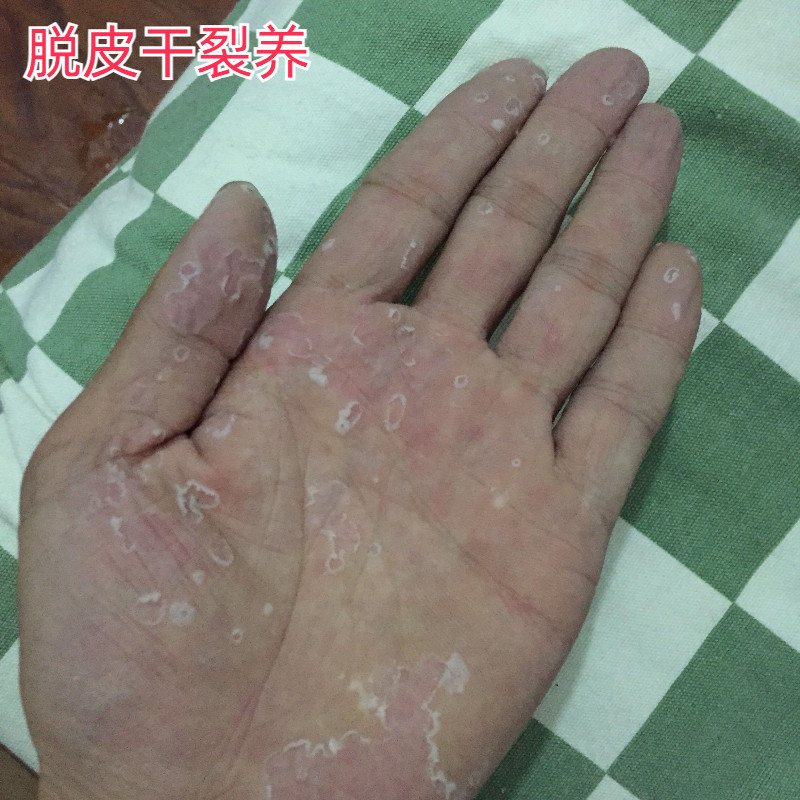今年手足脱皮膏手脱皮专用儿童手指头起皮脚干燥蜕皮干裂手掌掉皮