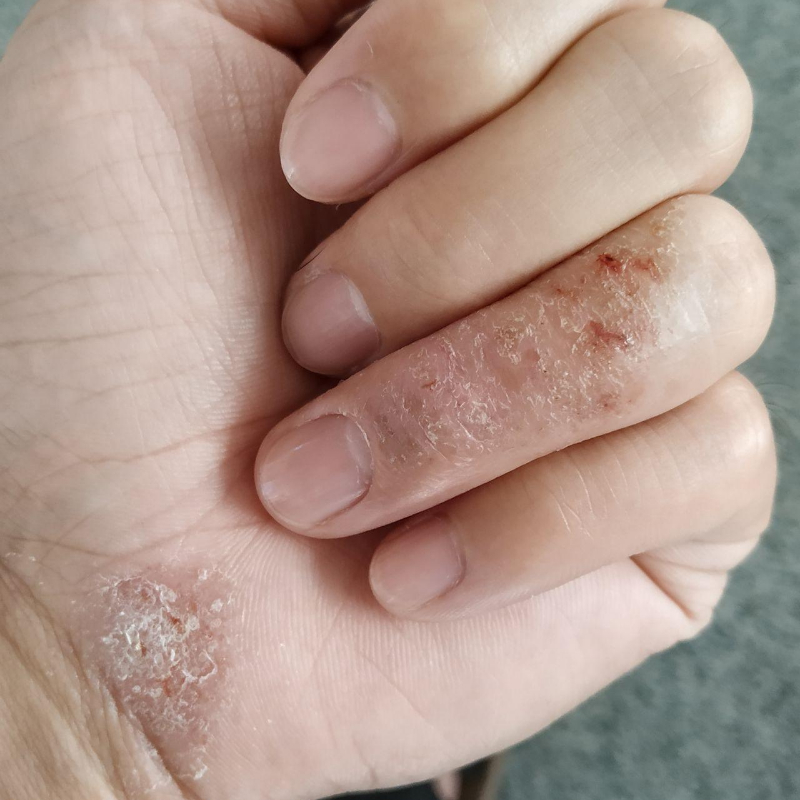 脱皮【手足脱皮软膏】季节性手脱皮蜕皮手指起皮干裂粗糙修护