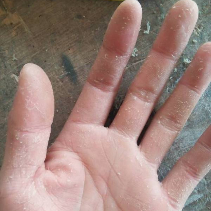 手痒起水泡手痒水泡脱皮干裂手上起小水泡手背手掌手指手掌痒膏