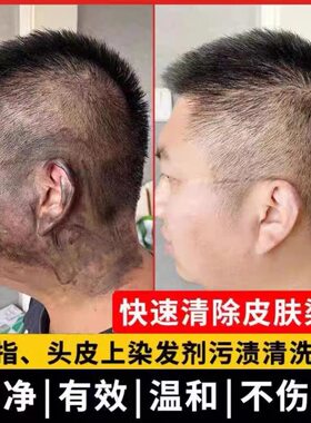 一擦净皮肤上染发膏的污渍