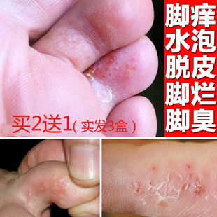 去脚气痒药香港脚药用膏