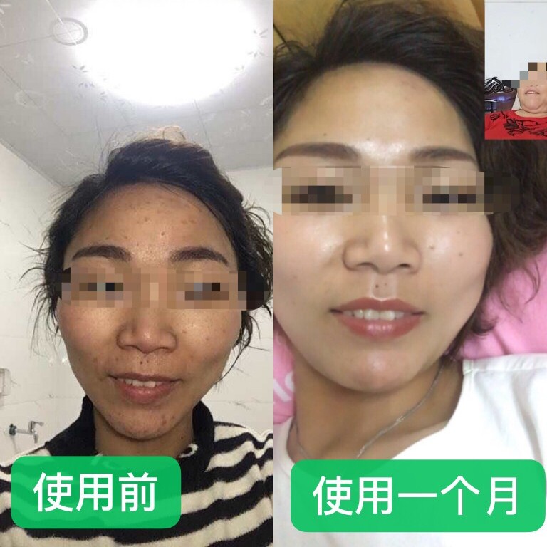 广东热销过千 面部护理美肤霜保湿祖传祛痘淡化痘印祛黄补水嫩肤