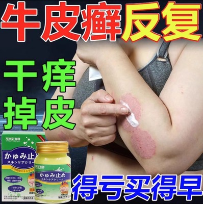 【银屑病专用药膏】根治不再犯