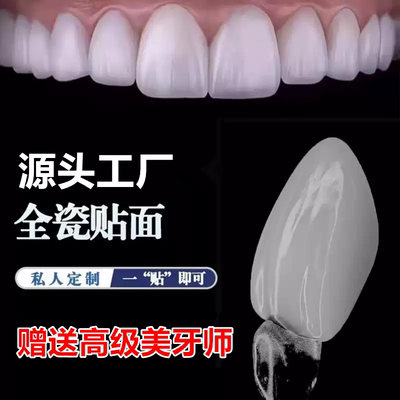 全瓷贴面超薄义获嘉灵犀瓷蓝瓷牙缝黄牙遮色美白瓷贴面牙齿贴片